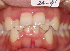 歯並び・咬み合わせ・八重歯・乱杭歯の矯正治療実績はこちら