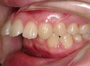 前歯、出っ歯・開咬の矯正治療実績はこちら
