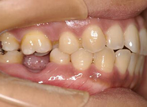 歯欠損の矯正治療実績はこちら