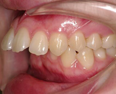 前歯・出っ歯・開咬の矯正治療を終えた患者さんからの口コミ・感想