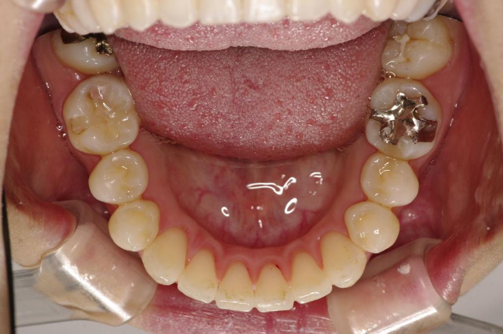 歯並び・咬み合わせ・八重歯・乱杭歯の矯正治療後口内写真NO.1128