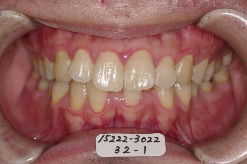 歯並び・咬み合わせ・八重歯・乱杭歯の矯正治療前口内写真NO.1129