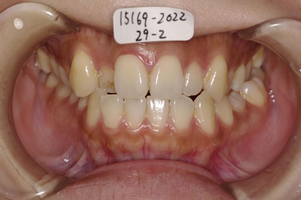 歯並び・咬み合わせ・八重歯・乱杭歯の矯正治療前口内写真NO.1130