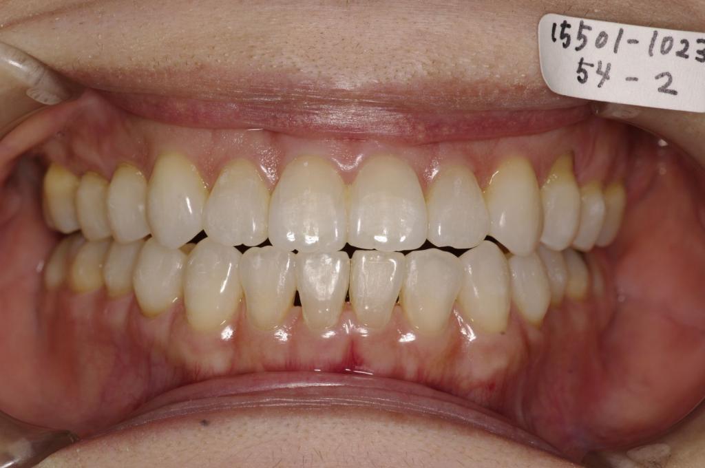 歯並び・咬み合わせ・八重歯・乱杭歯の矯正治療後口内写真NO.1132