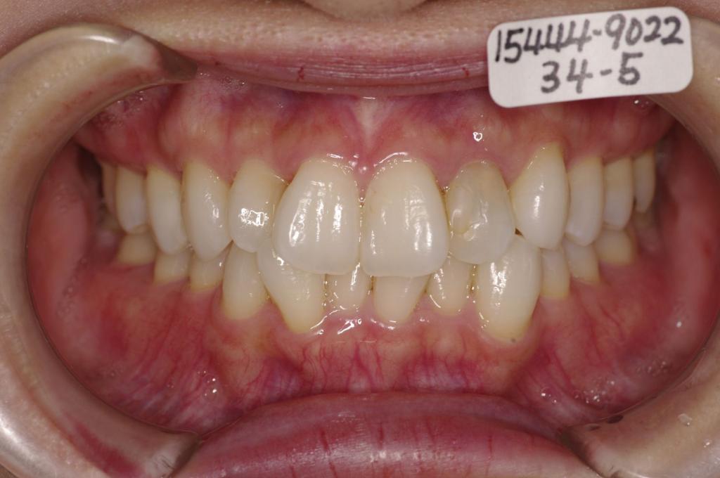 歯並び・咬み合わせ・八重歯・乱杭歯の矯正治療前口内写真NO.1133