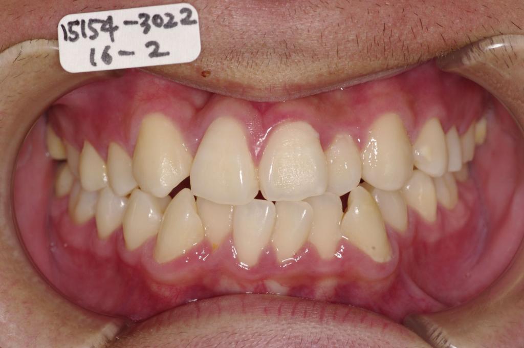 歯並び・咬み合わせ・八重歯・乱杭歯の矯正治療前口内写真NO.1135