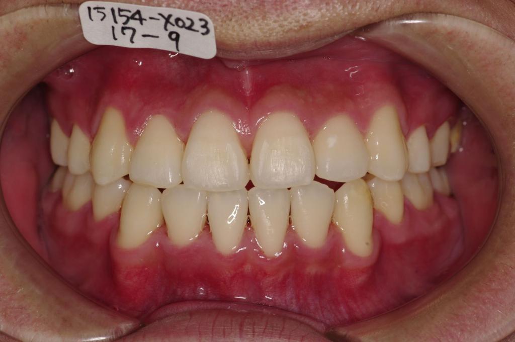 歯並び・咬み合わせ・八重歯・乱杭歯の矯正治療後口内写真NO.1135