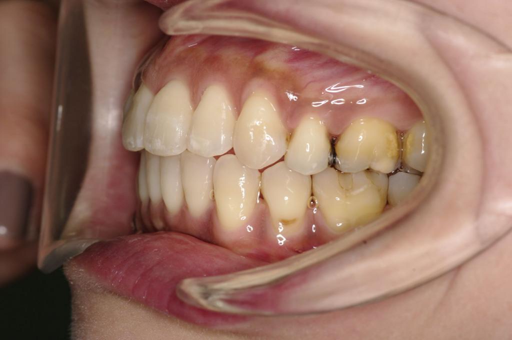 歯並び・咬み合わせ・八重歯・乱杭歯の矯正治療後口内写真NO.1136