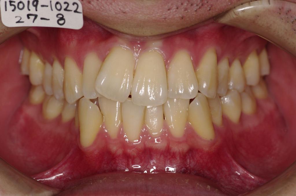 歯並び・咬み合わせ・八重歯・乱杭歯の矯正治療前口内写真NO.1149