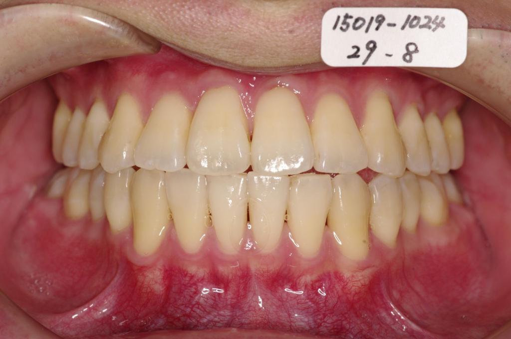 歯並び・咬み合わせ・八重歯・乱杭歯の矯正治療後口内写真NO.1149
