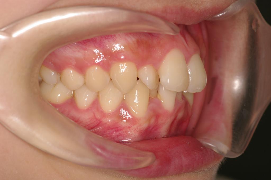 歯並び・咬み合わせ・八重歯・乱杭歯の矯正治療前口内写真NO.1150
