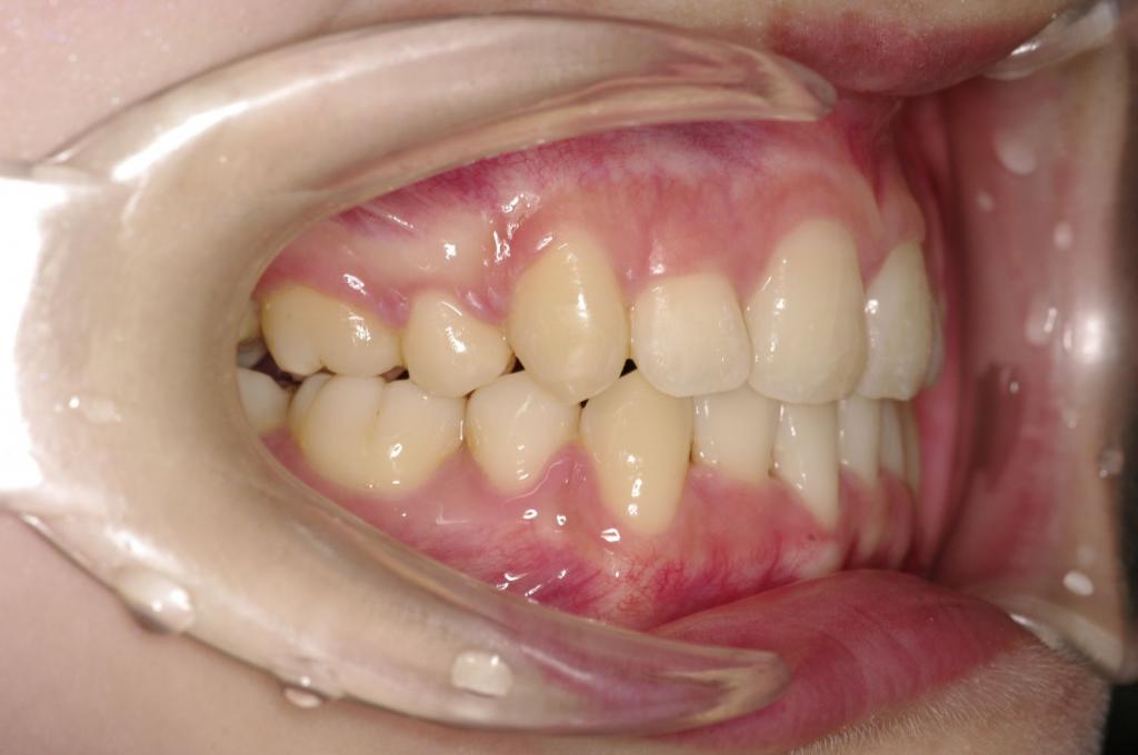 歯並び・咬み合わせ・八重歯・乱杭歯の矯正治療後口内写真NO.1150