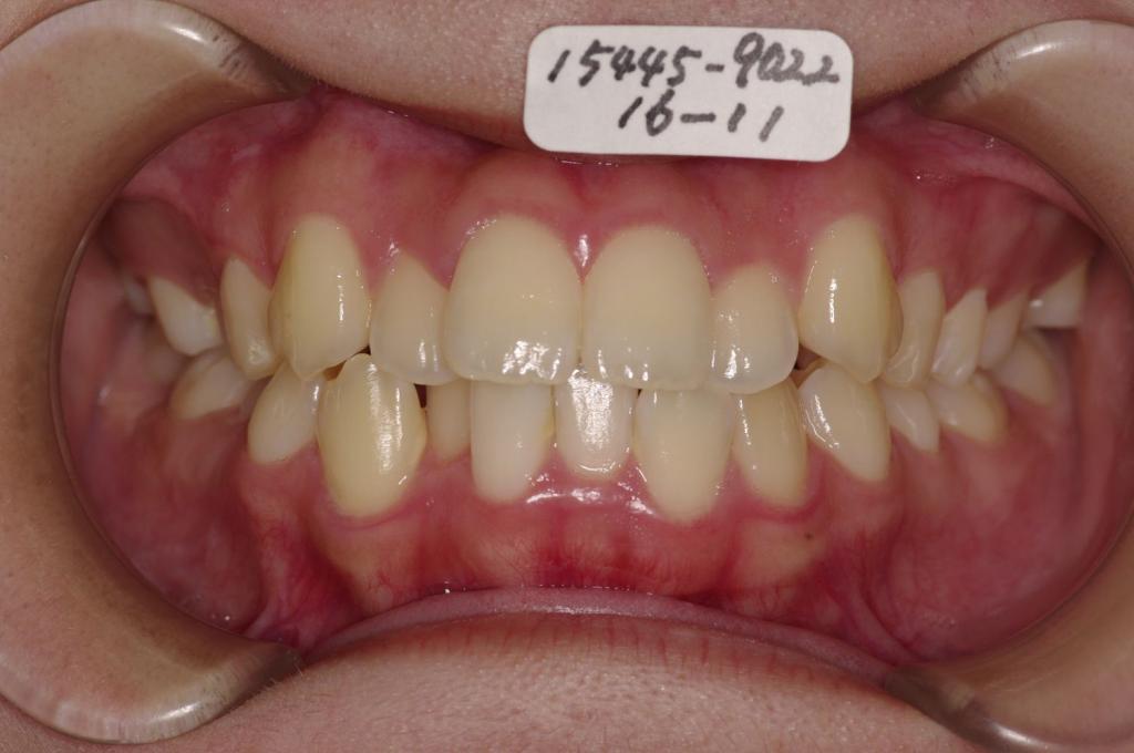 歯並び・咬み合わせ・八重歯・乱杭歯の矯正治療前口内写真NO.1151