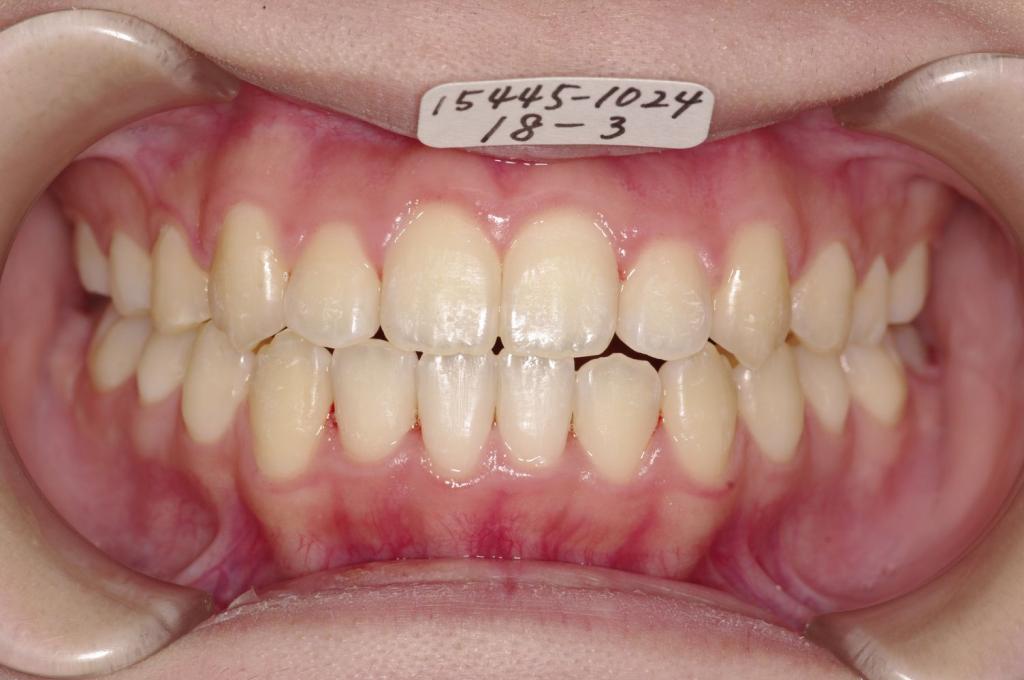 歯並び・咬み合わせ・八重歯・乱杭歯の矯正治療後口内写真NO.1151