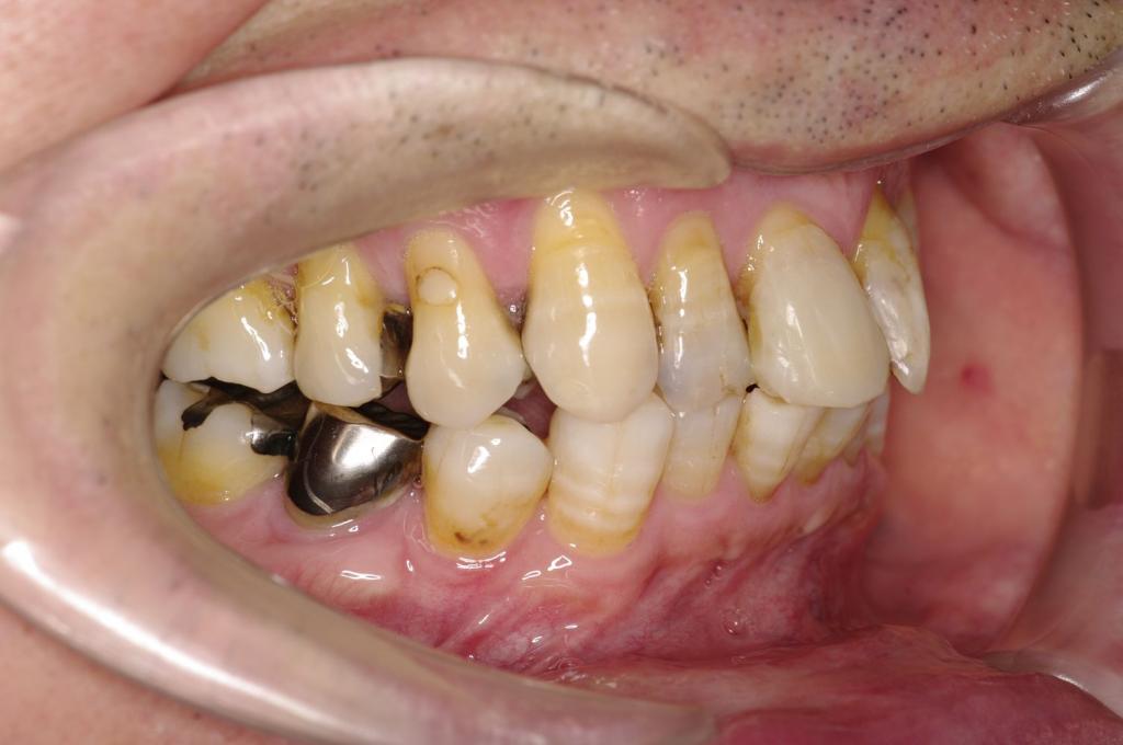 歯並び・咬み合わせ・八重歯・乱杭歯の矯正治療前口内写真NO.1152