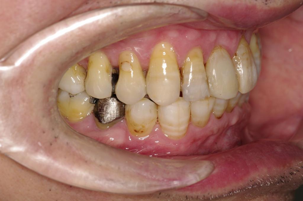 歯並び・咬み合わせ・八重歯・乱杭歯の矯正治療後口内写真NO.1152