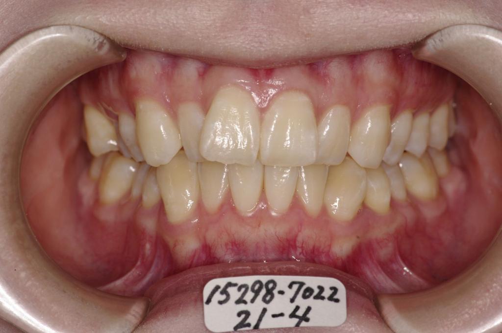 歯並び・咬み合わせ・八重歯・乱杭歯の矯正治療前口内写真NO.1153