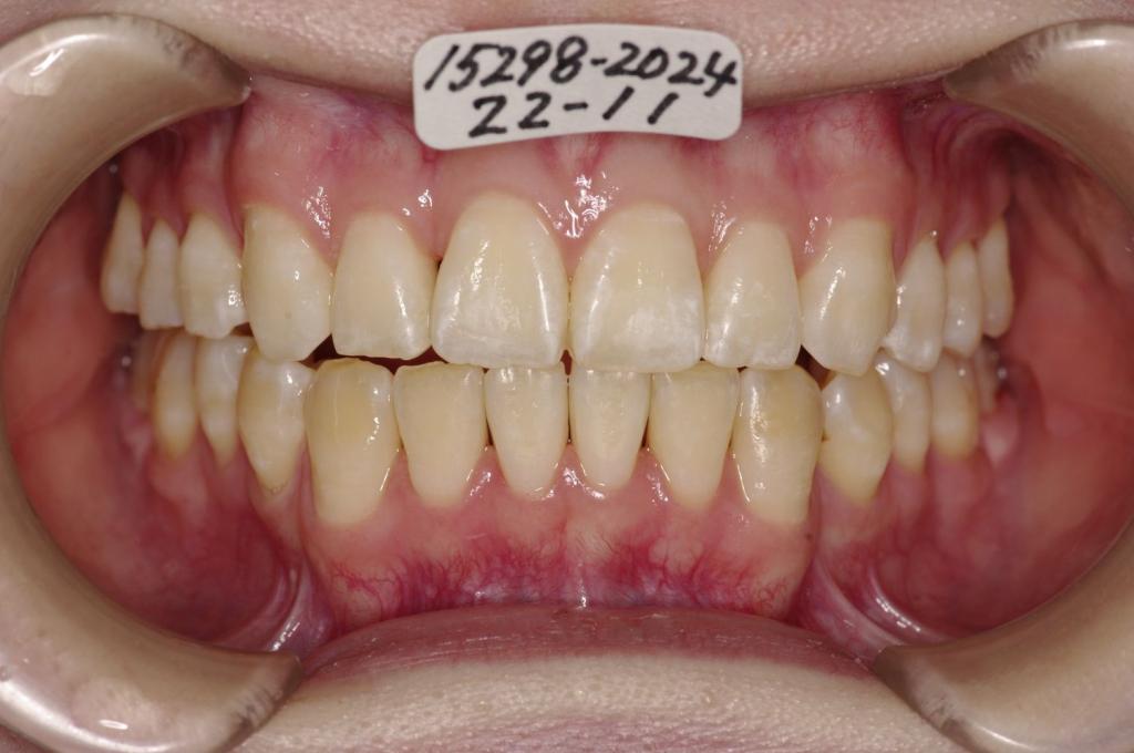 歯並び・咬み合わせ・八重歯・乱杭歯の矯正治療後口内写真NO.1153