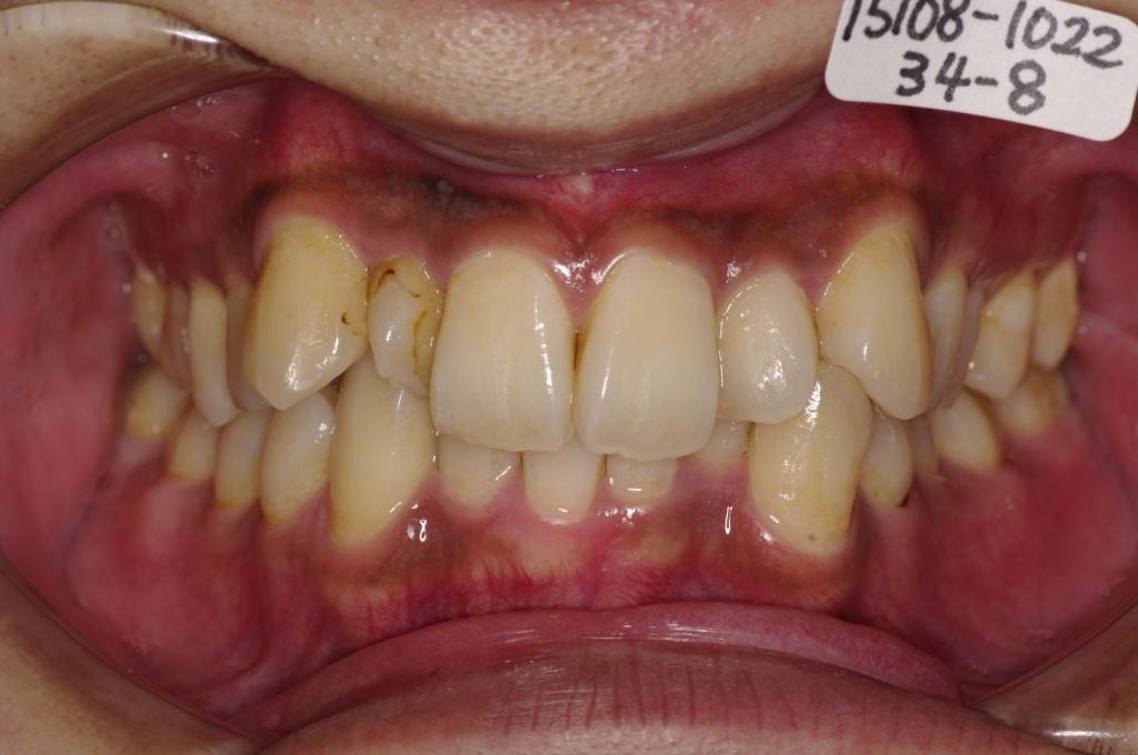 歯並び・咬み合わせ・八重歯・乱杭歯の矯正治療前口内写真NO.1154