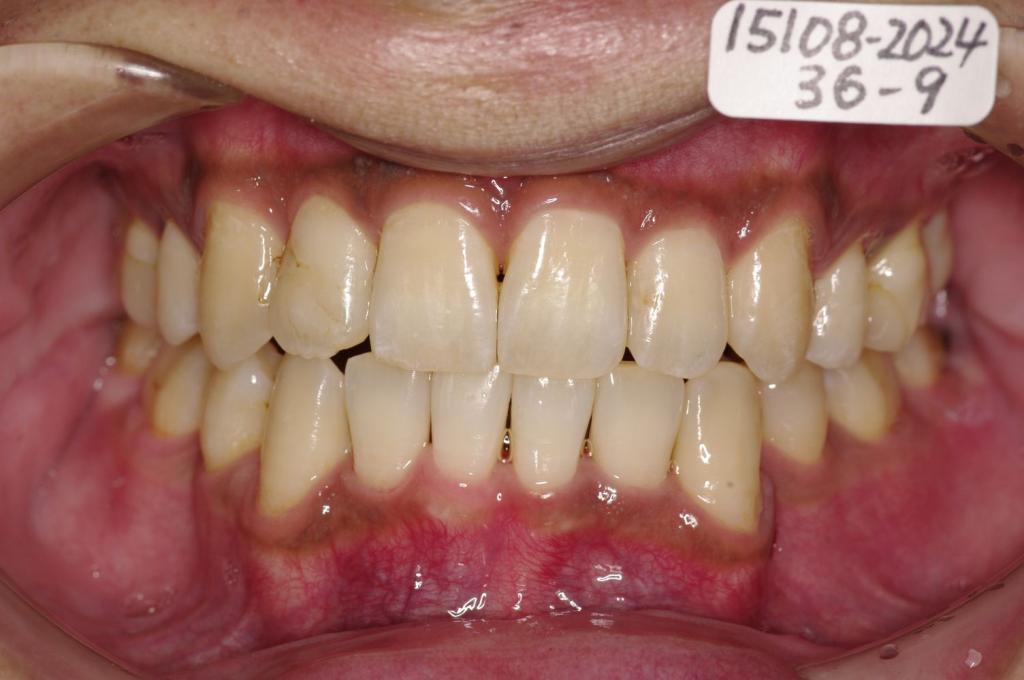 歯並び・咬み合わせ・八重歯・乱杭歯の矯正治療後口内写真NO.1154
