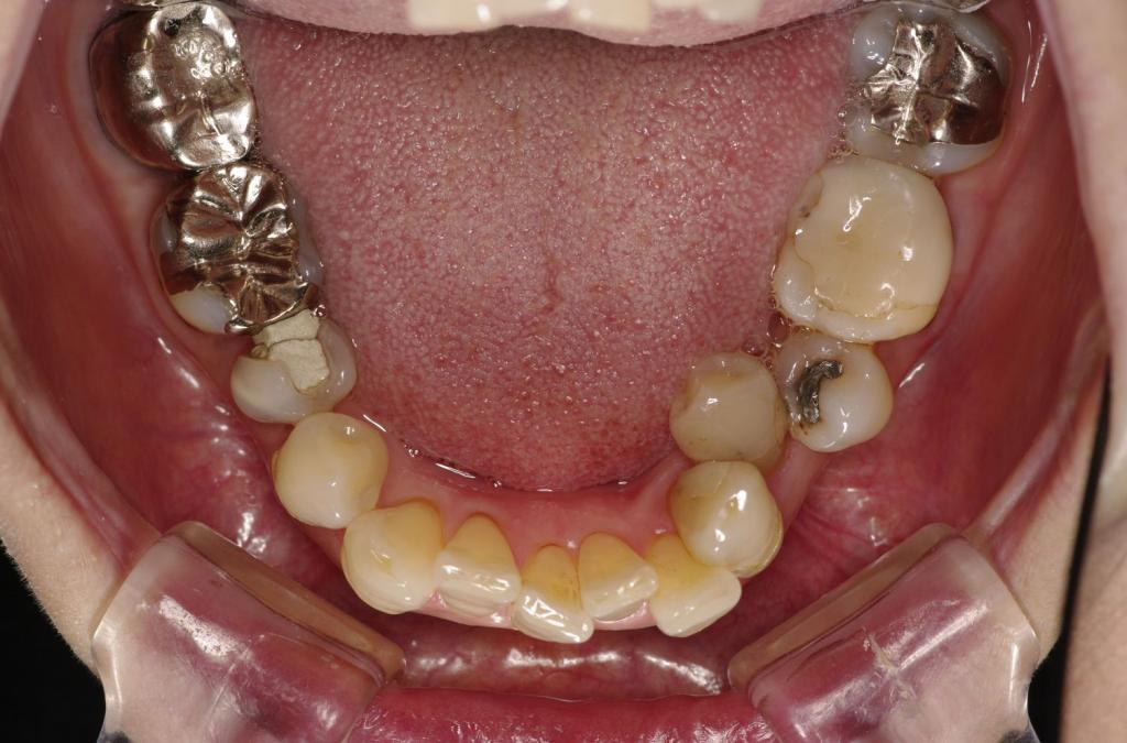 歯並び・咬み合わせ・八重歯・乱杭歯の矯正治療前口内写真NO.1155