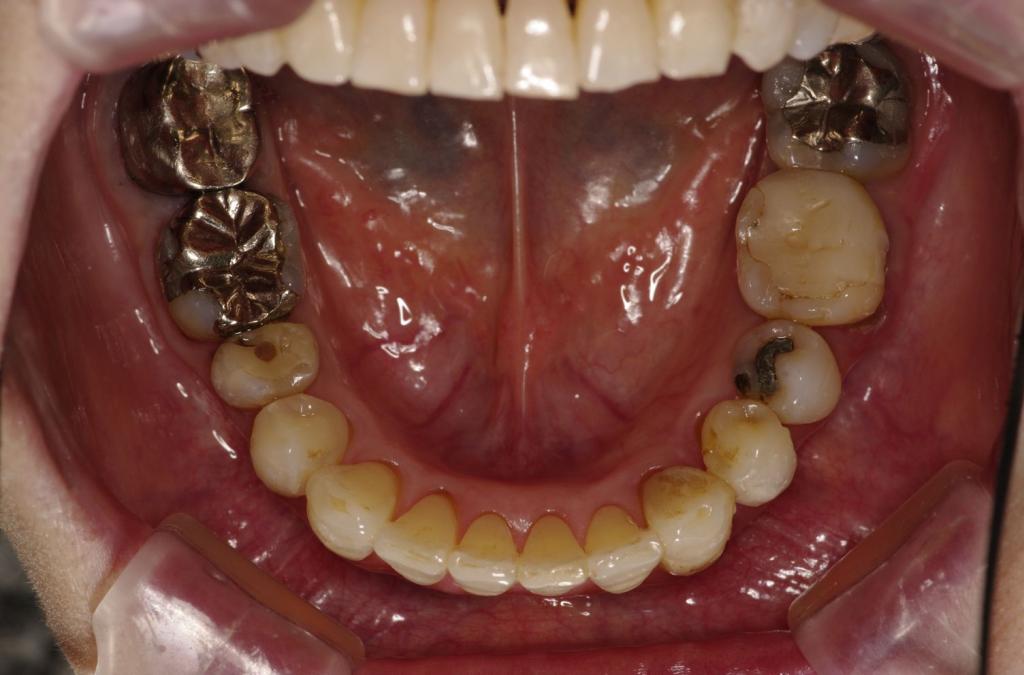 歯並び・咬み合わせ・八重歯・乱杭歯の矯正治療後口内写真NO.1155