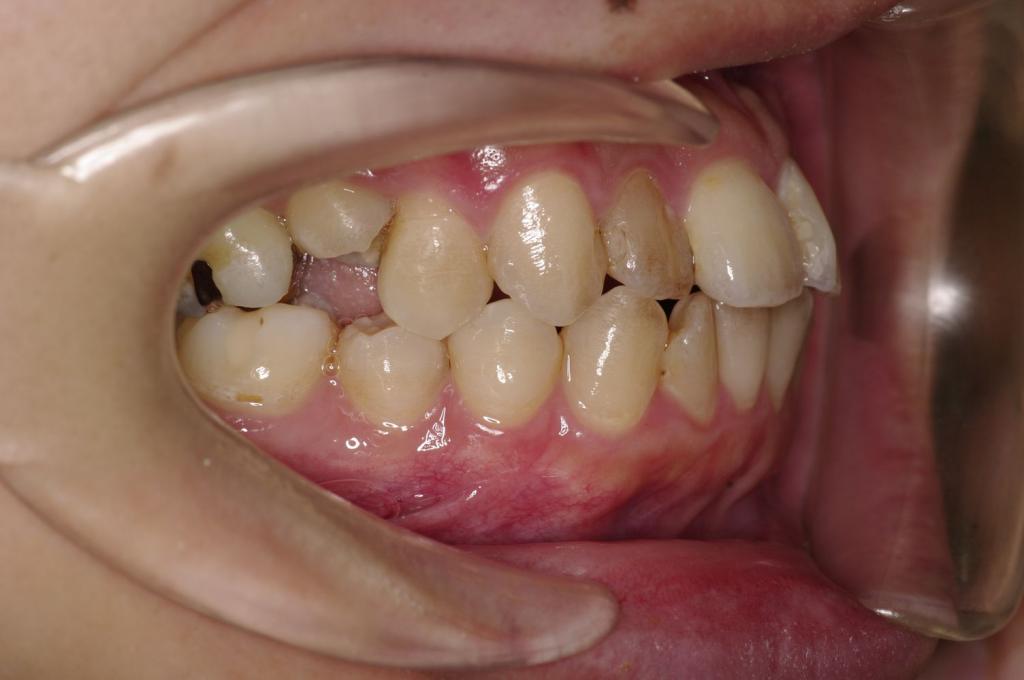 歯並び・咬み合わせ・八重歯・乱杭歯の矯正治療前口内写真NO.1156