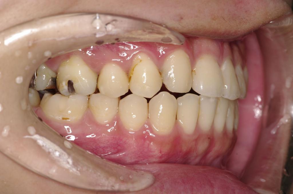 歯並び・咬み合わせ・八重歯・乱杭歯の矯正治療後口内写真NO.1156