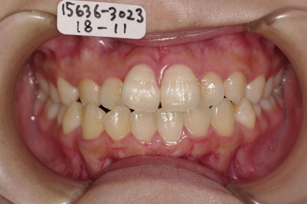 歯並び・咬み合わせ・八重歯・乱杭歯の矯正治療前口内写真NO.1157