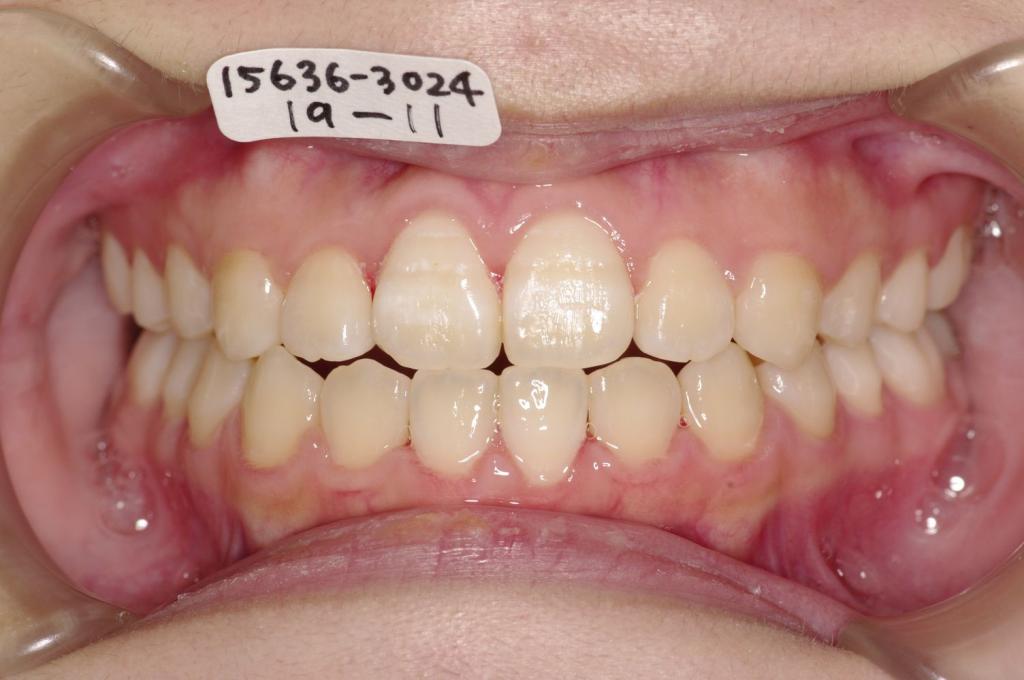 歯並び・咬み合わせ・八重歯・乱杭歯の矯正治療後口内写真NO.1157