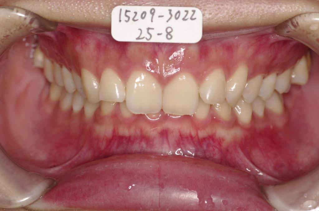 歯並び・咬み合わせ・八重歯・乱杭歯の矯正治療前口内写真NO.1158