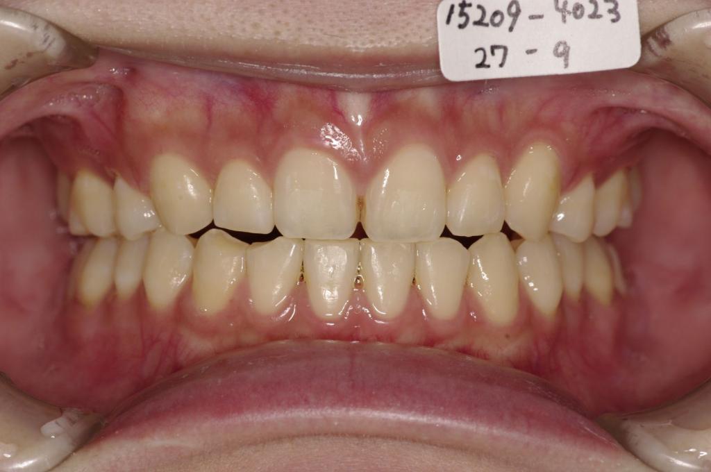 歯並び・咬み合わせ・八重歯・乱杭歯の矯正治療後口内写真NO.1158