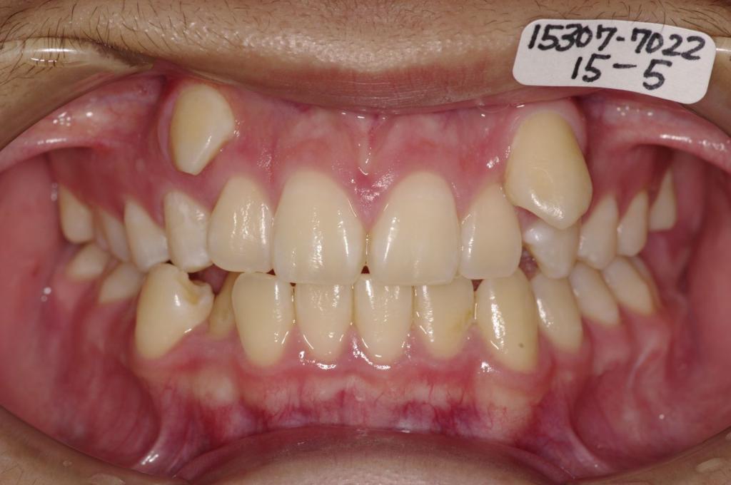 歯並び・咬み合わせ・八重歯・乱杭歯の矯正治療前口内写真NO.1159