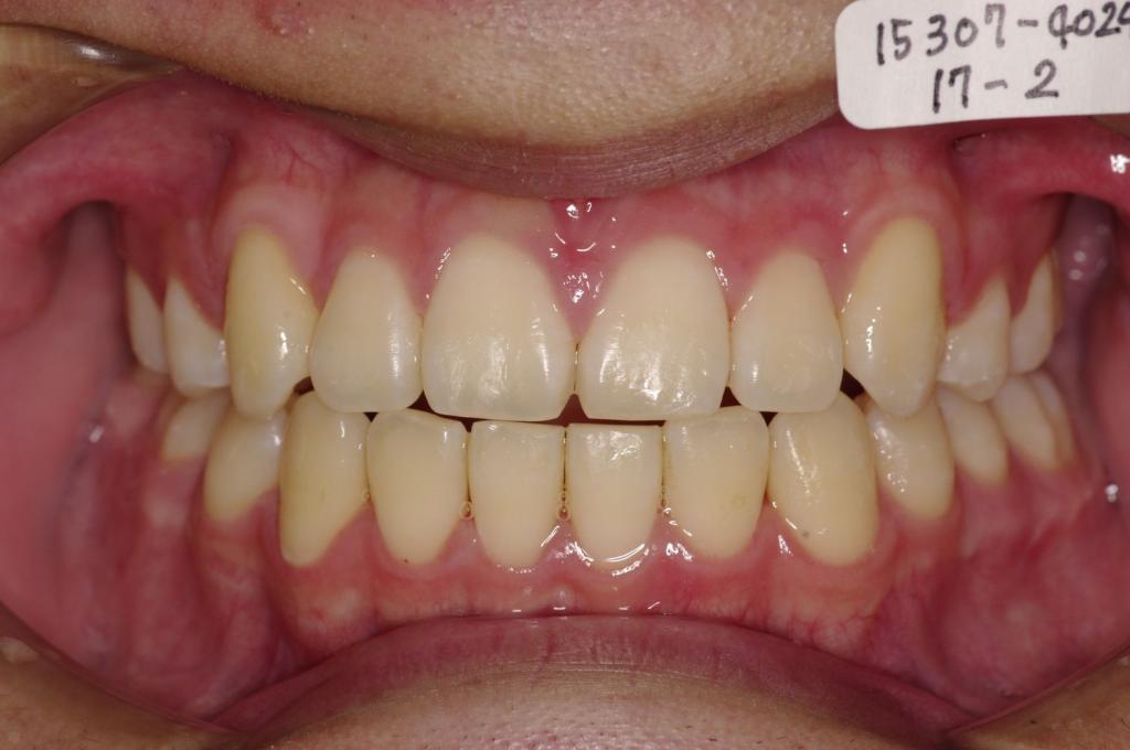 歯並び・咬み合わせ・八重歯・乱杭歯の矯正治療後口内写真NO.1159