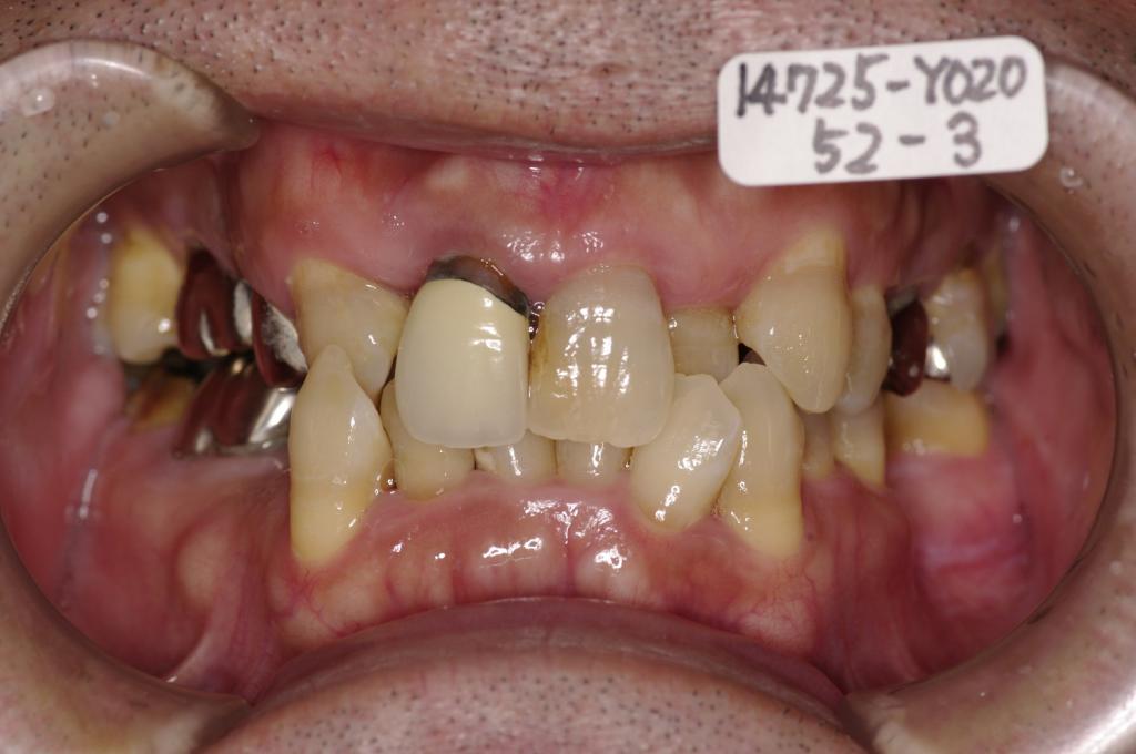 歯並び・咬み合わせ・八重歯・乱杭歯の矯正治療前口内写真NO.1160