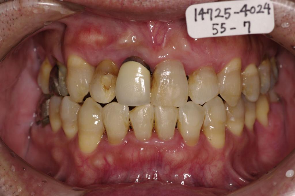 歯並び・咬み合わせ・八重歯・乱杭歯の矯正治療後口内写真NO.1160