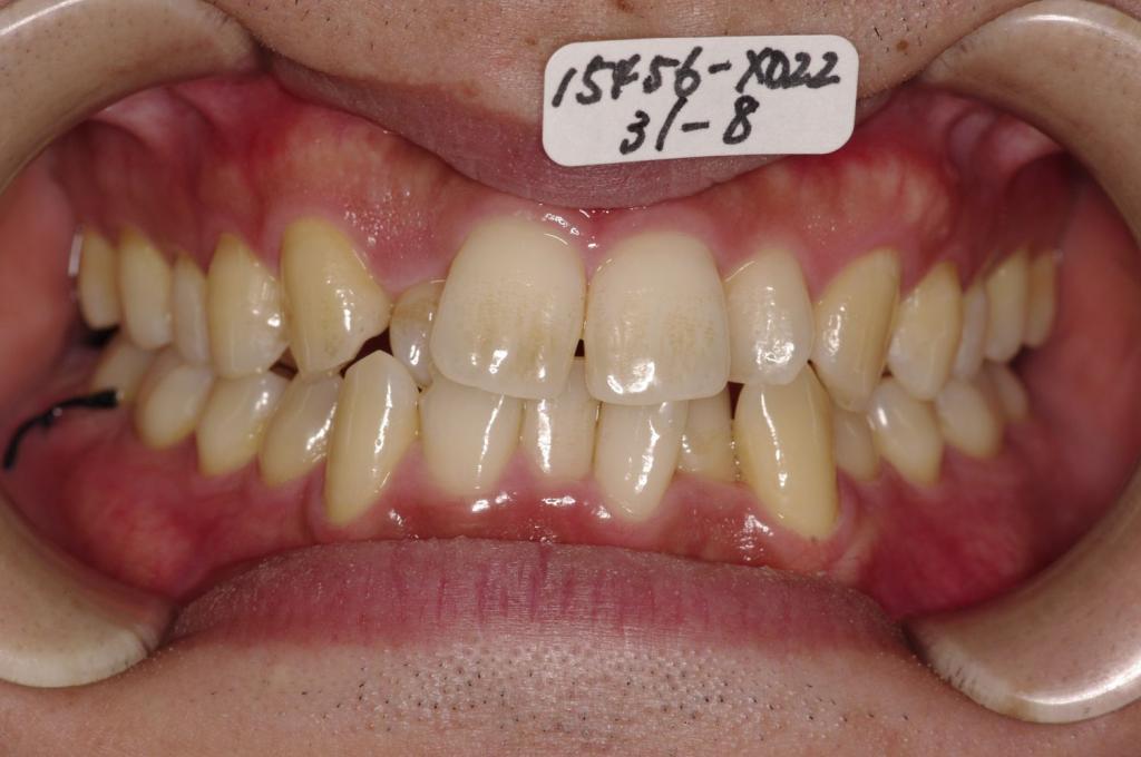 歯並び・咬み合わせ・八重歯・乱杭歯の矯正治療前口内写真NO.1161
