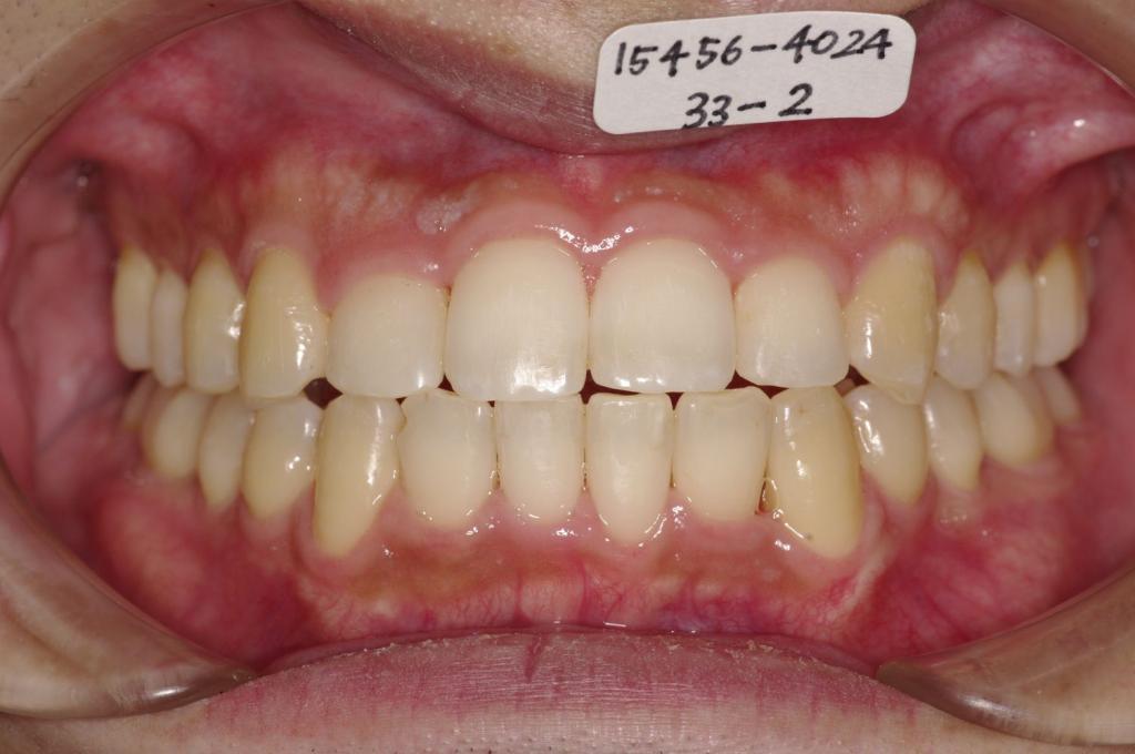 歯並び・咬み合わせ・八重歯・乱杭歯の矯正治療後口内写真NO.1161