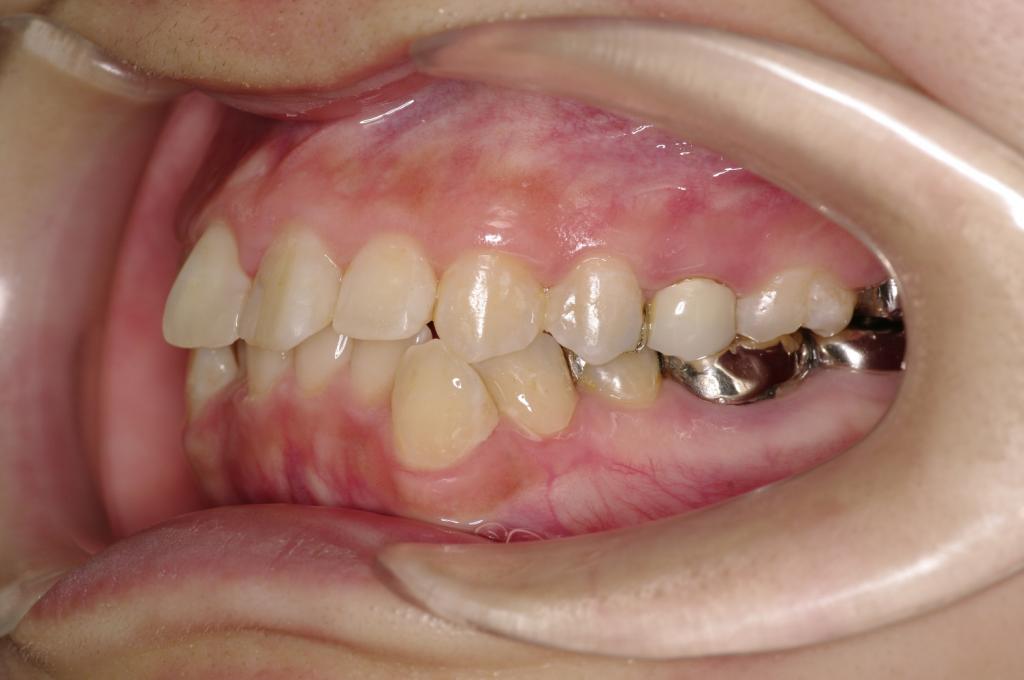 歯並び・咬み合わせ・八重歯・乱杭歯の矯正治療前口内写真NO.1162