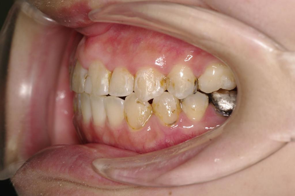 歯並び・咬み合わせ・八重歯・乱杭歯の矯正治療後口内写真NO.1162