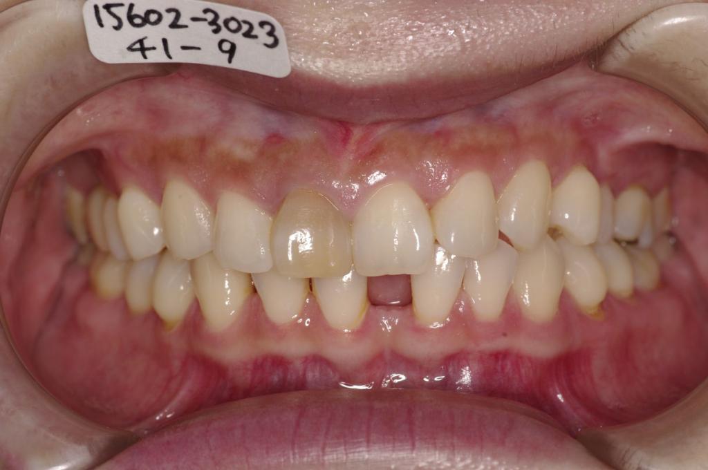 歯並び・咬み合わせ・八重歯・乱杭歯の矯正治療前口内写真NO.1163