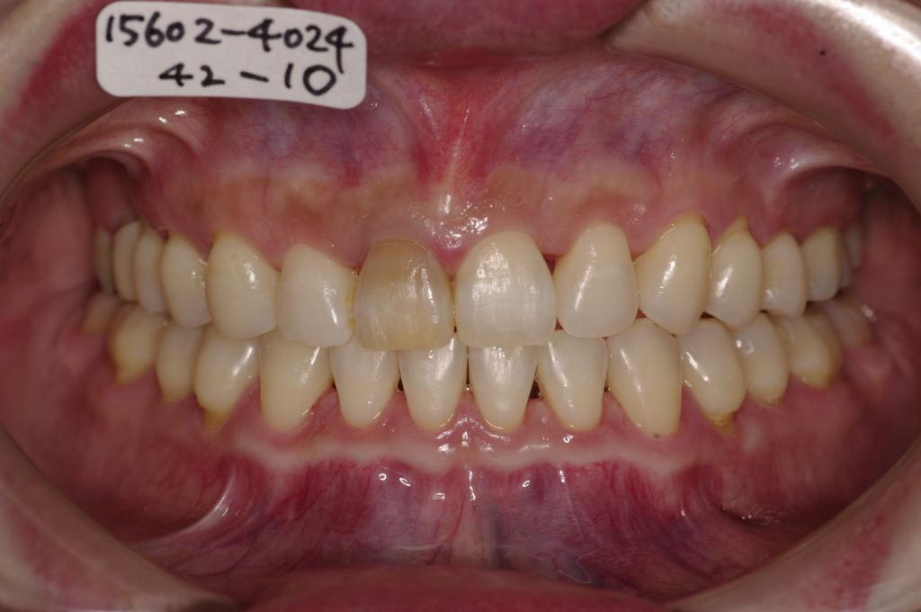 歯並び・咬み合わせ・八重歯・乱杭歯の矯正治療後口内写真NO.1163