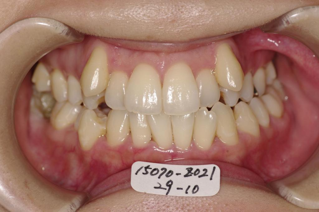 歯並び・咬み合わせ・八重歯・乱杭歯の矯正治療前口内写真NO.1164