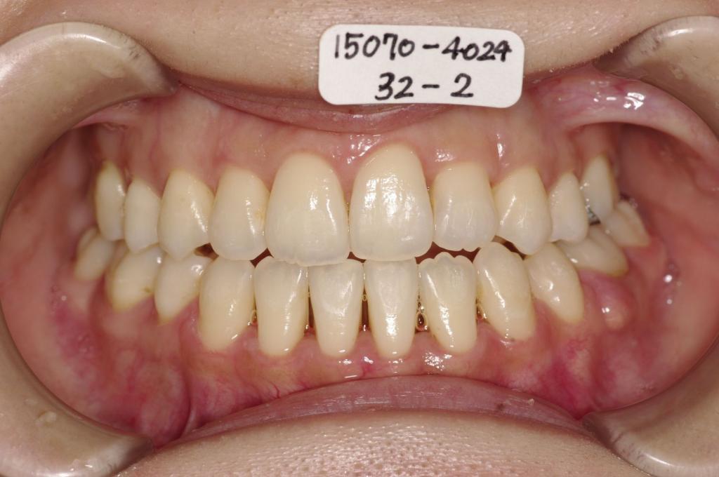 歯並び・咬み合わせ・八重歯・乱杭歯の矯正治療後口内写真NO.1164