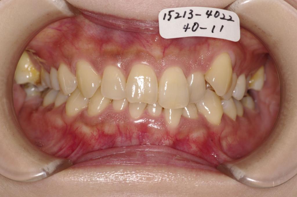 歯並び・咬み合わせ・八重歯・乱杭歯の矯正治療前口内写真NO.1165