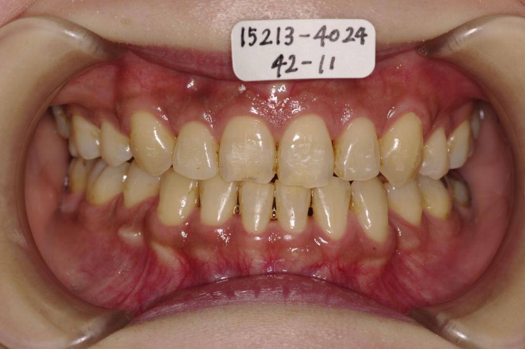 歯並び・咬み合わせ・八重歯・乱杭歯の矯正治療後口内写真NO.1165