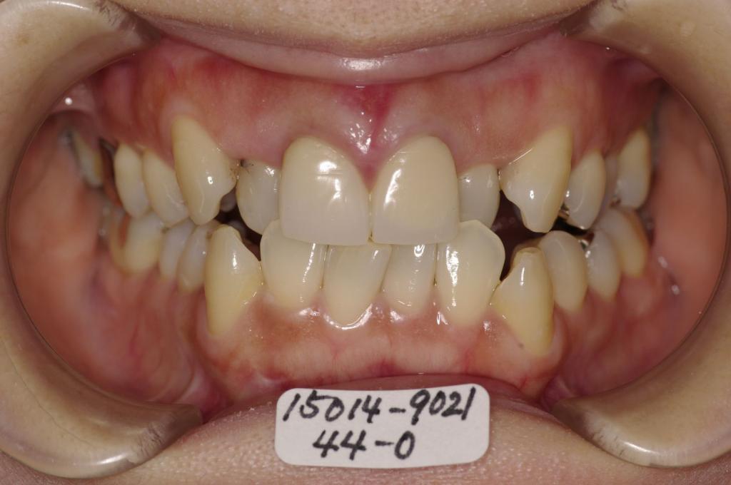 歯並び・咬み合わせ・八重歯・乱杭歯の矯正治療前口内写真NO.1166