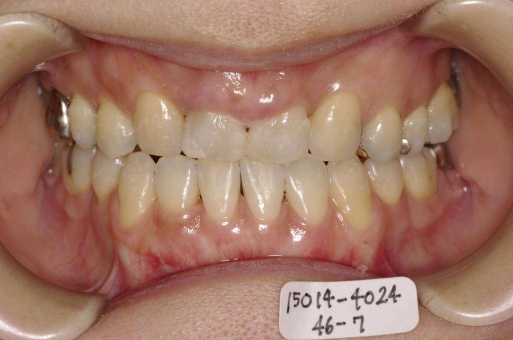 歯並び・咬み合わせ・八重歯・乱杭歯の矯正治療後口内写真NO.1166
