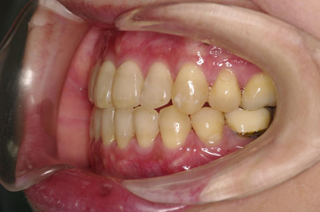前歯、出っ歯・開咬の矯正治療後口内写真NO.1000