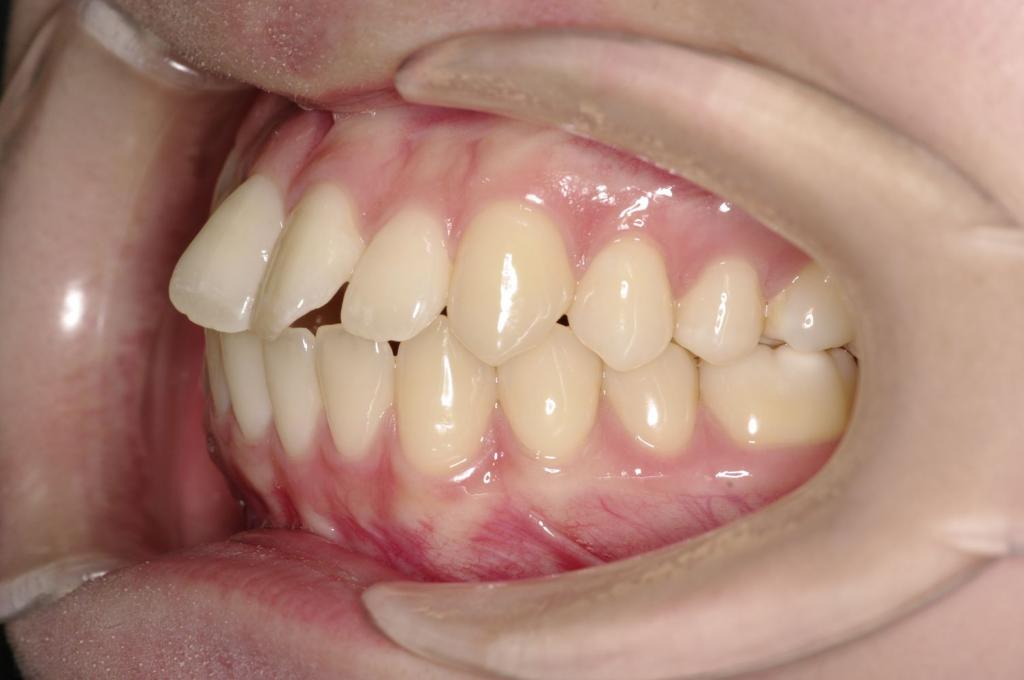 前歯、出っ歯・開咬の矯正治療前口内写真NO.1001